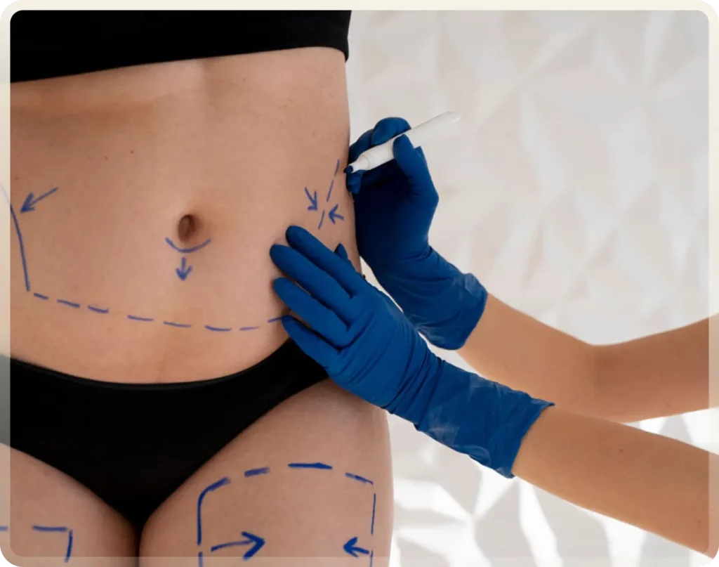Abdominoplasty turkey