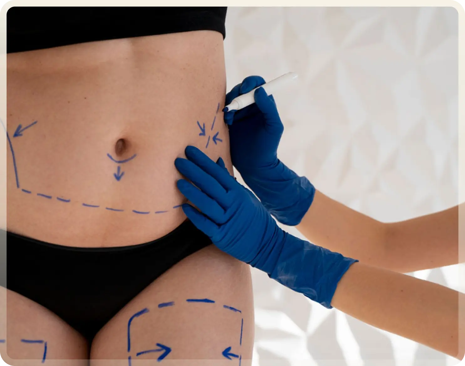 Tummy Tuck Turkey - Abdominoplasty at Carely Clinic Istanbul
