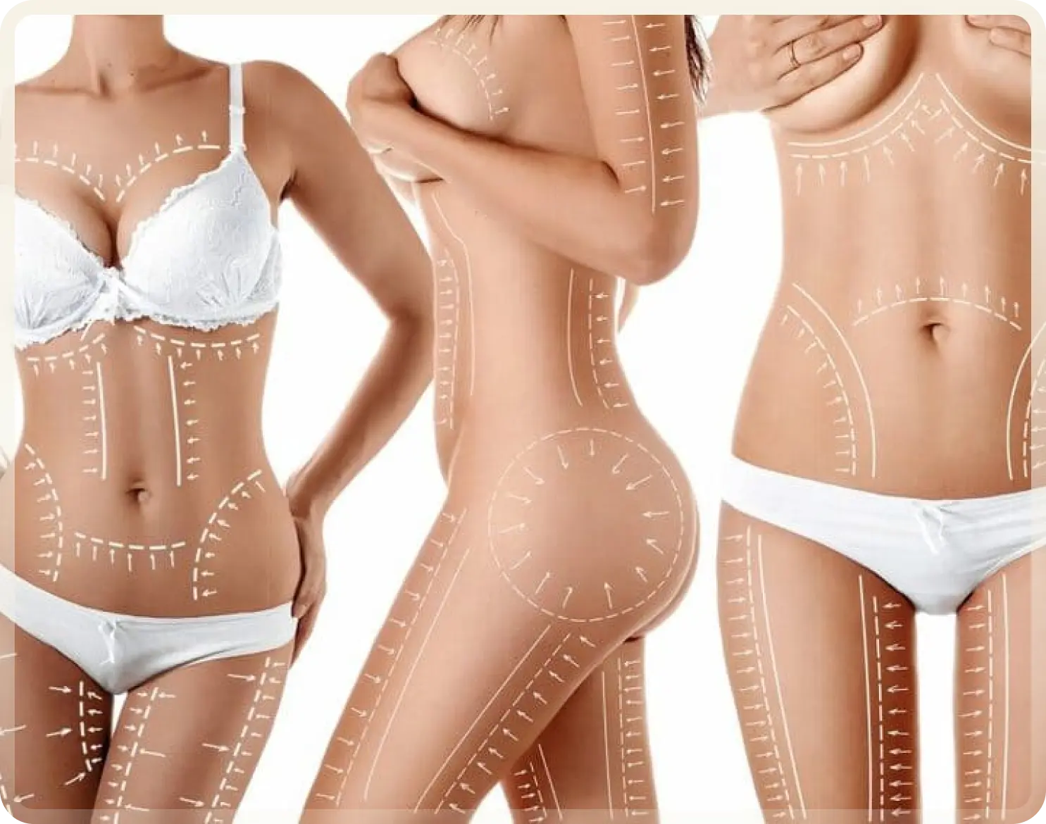 Body Lift Turkey - Circumferential body lift at Carely Clinic Istanbul