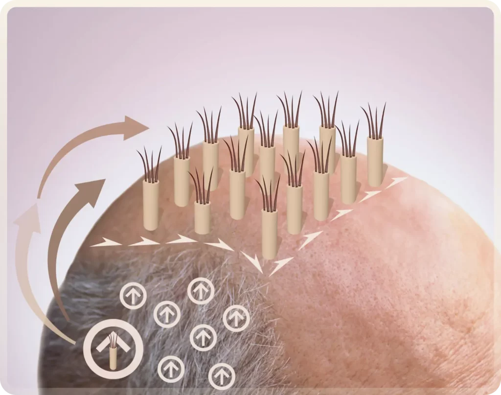 FUE Hair Transplant turkey