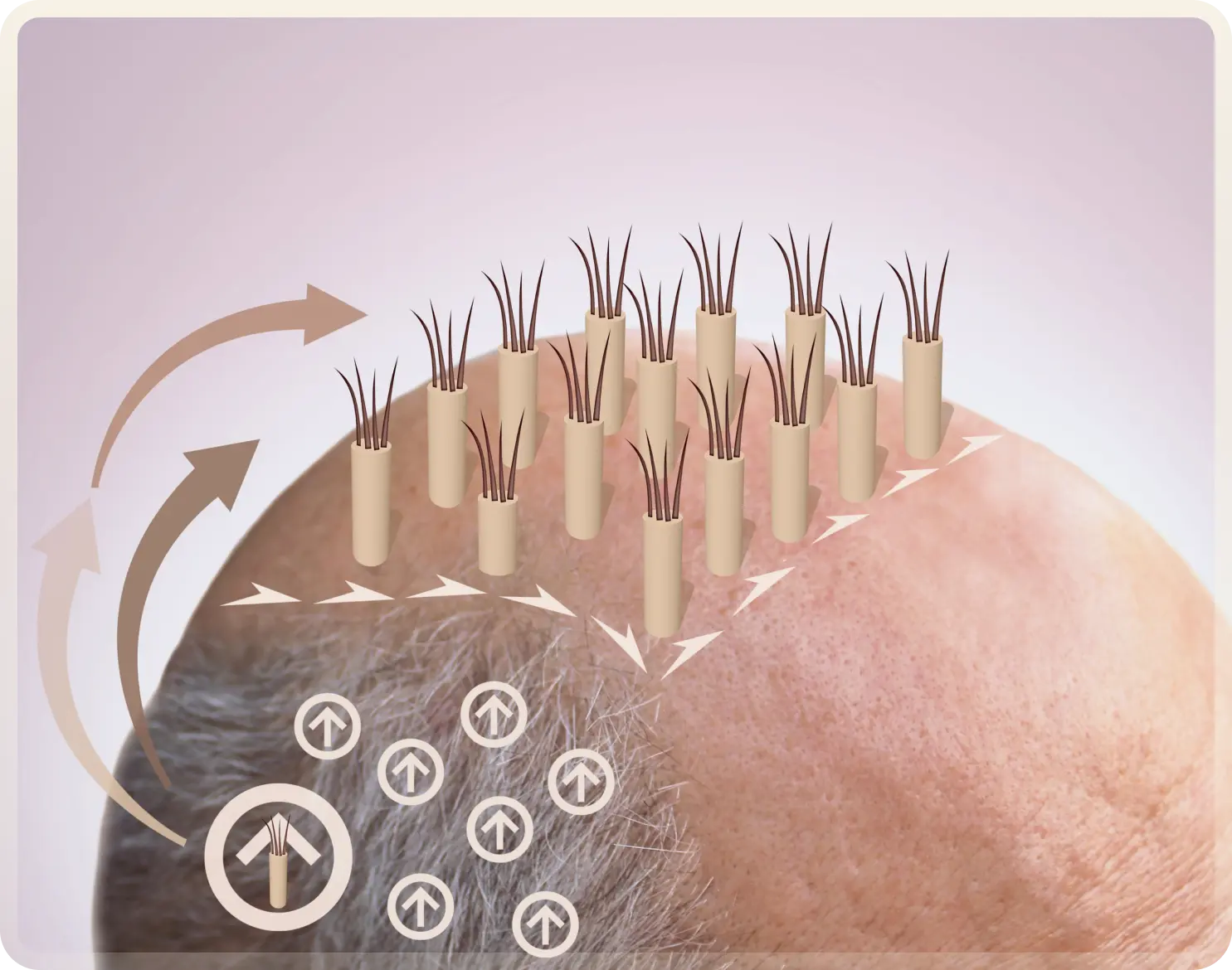 FUE Hair Transplant Turkey - Follicular Unit Extraction at Carely Clinic