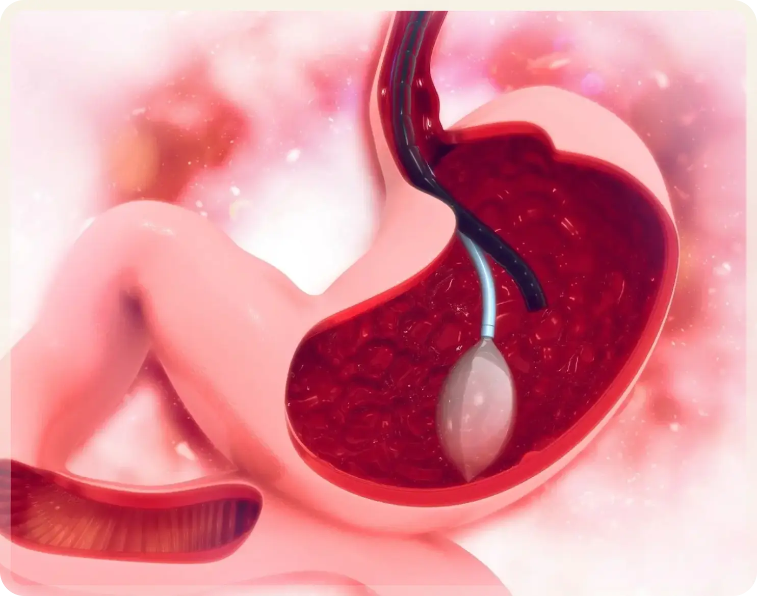 Gastric Balloon Turkey
