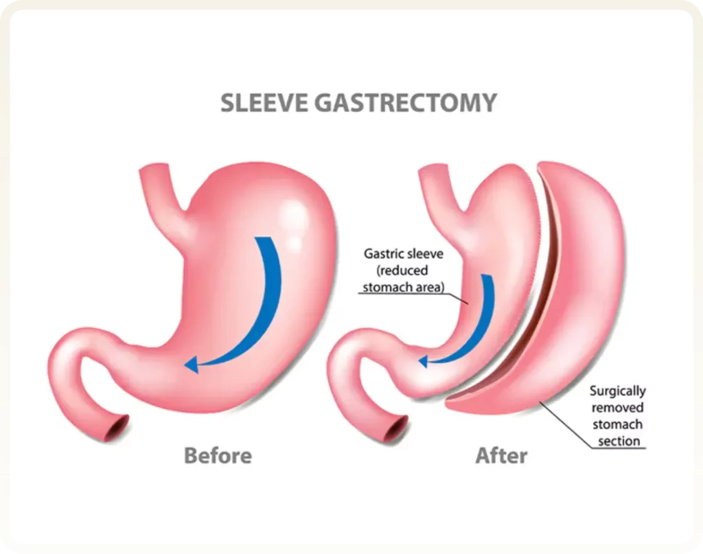Gastric Sleeve Turkey