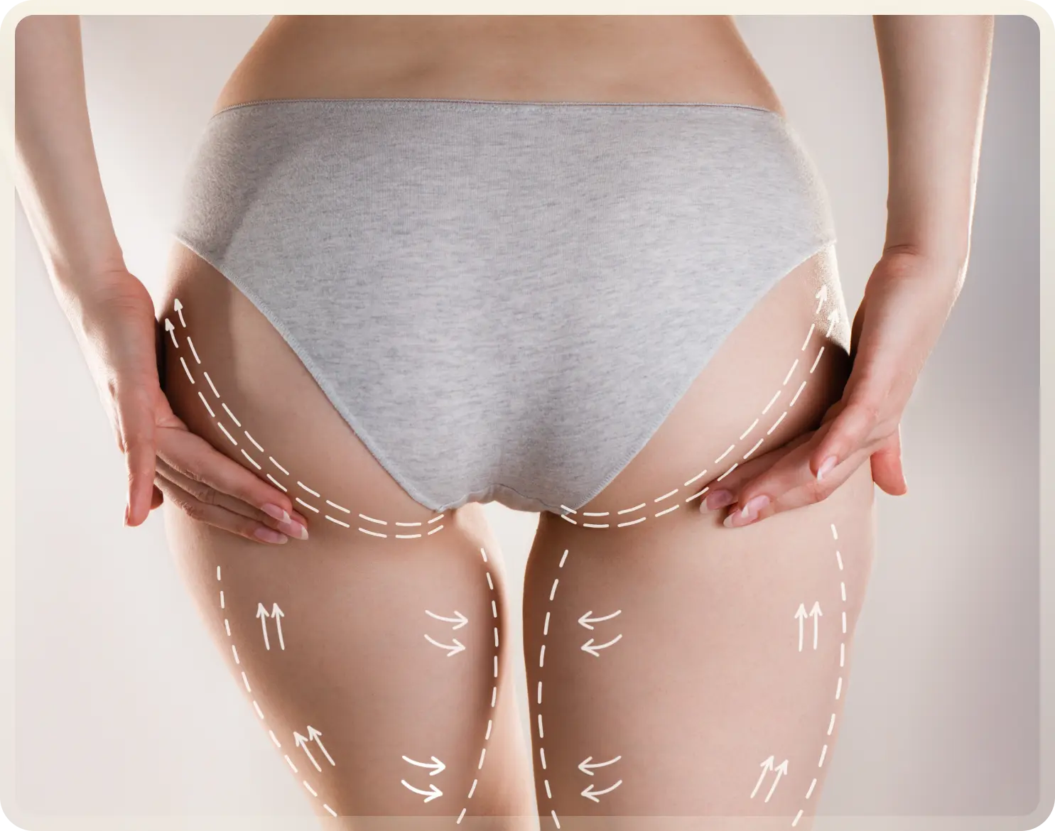 BBL Turkey - Brazilian Butt Lift at Carely Clinic Istanbul