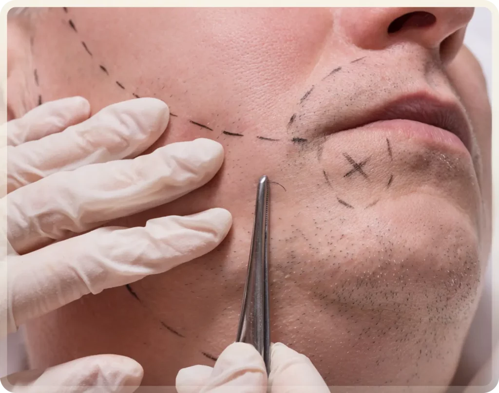 beard transplant turkey