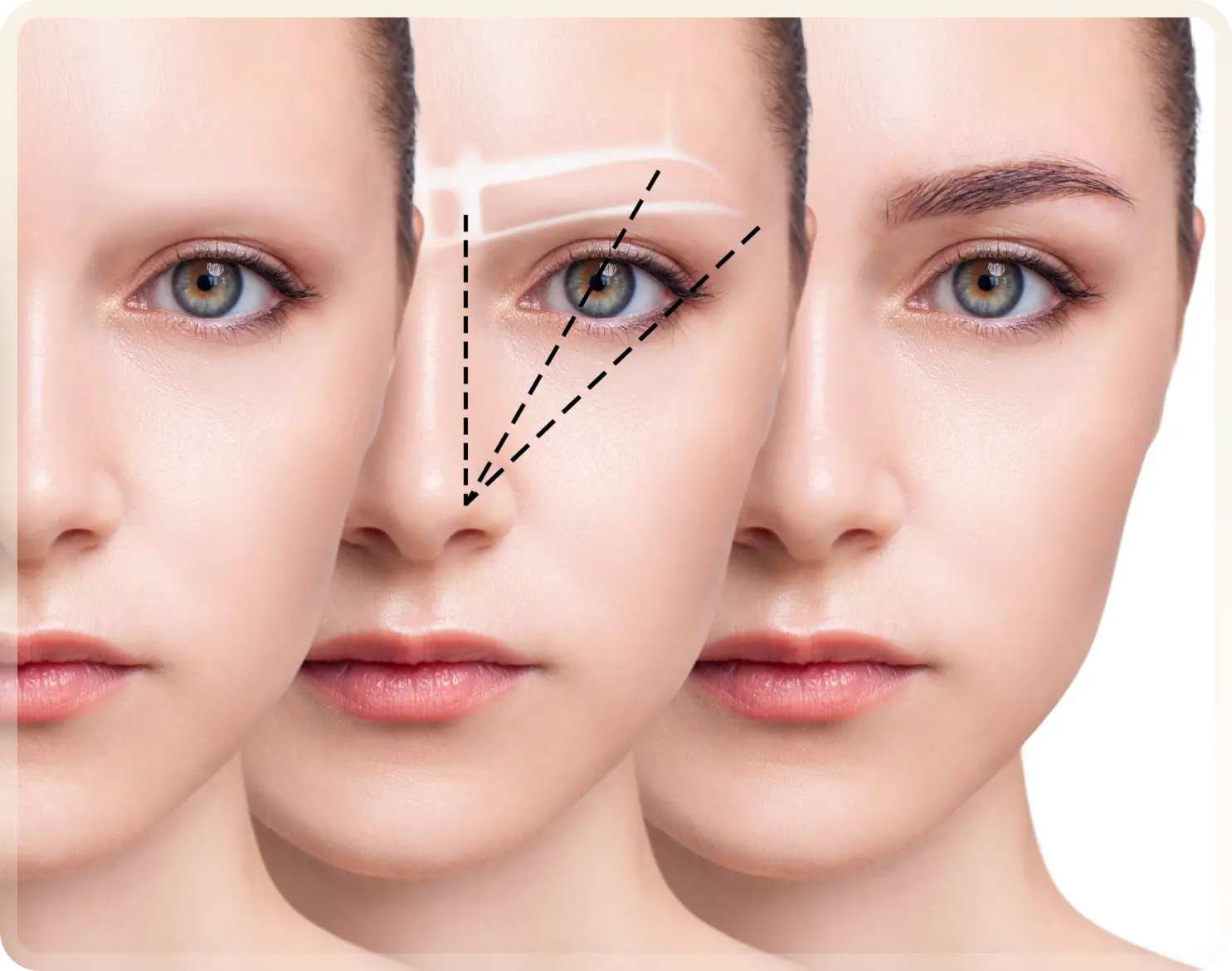 Eyebrow Transplant Turkey - Brow restoration at Carely Clinic