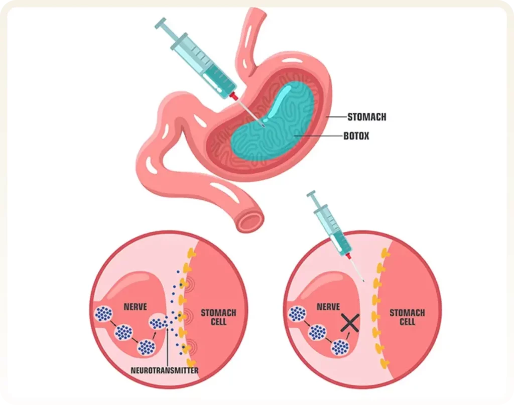 gastric botox turkey
