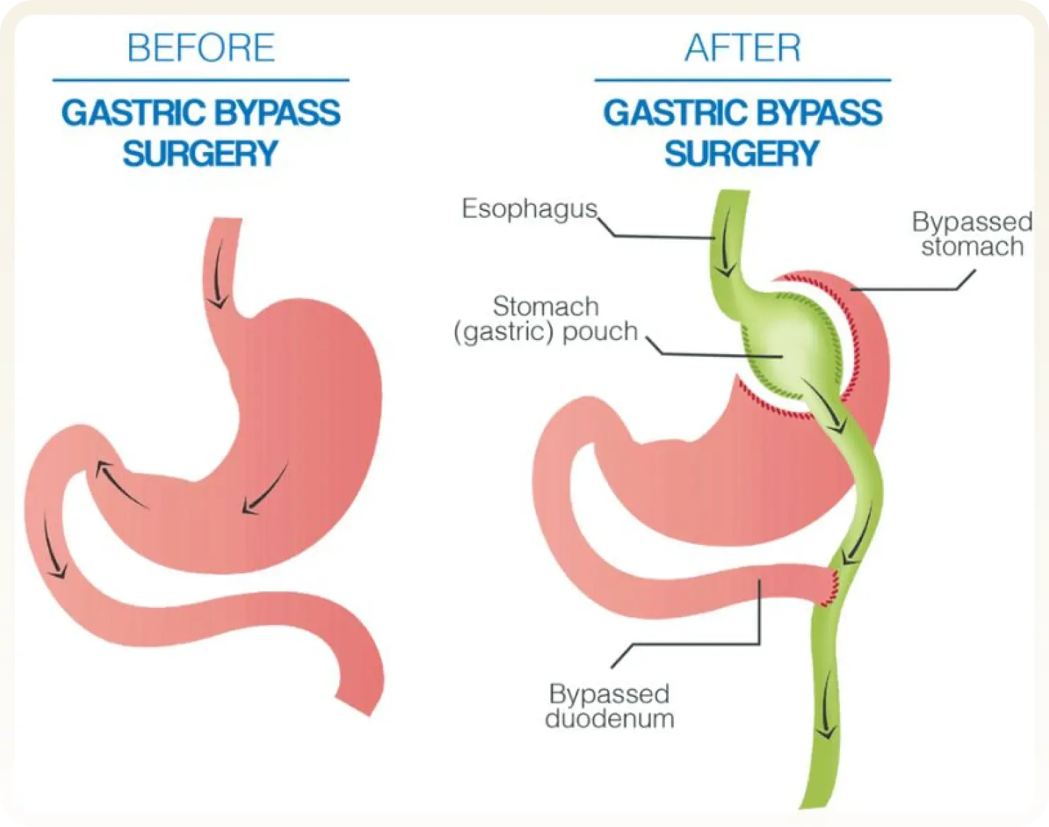 Gastric Bypass Turkey - Roux-en-Y bypass at Carely Clinic Istanbul