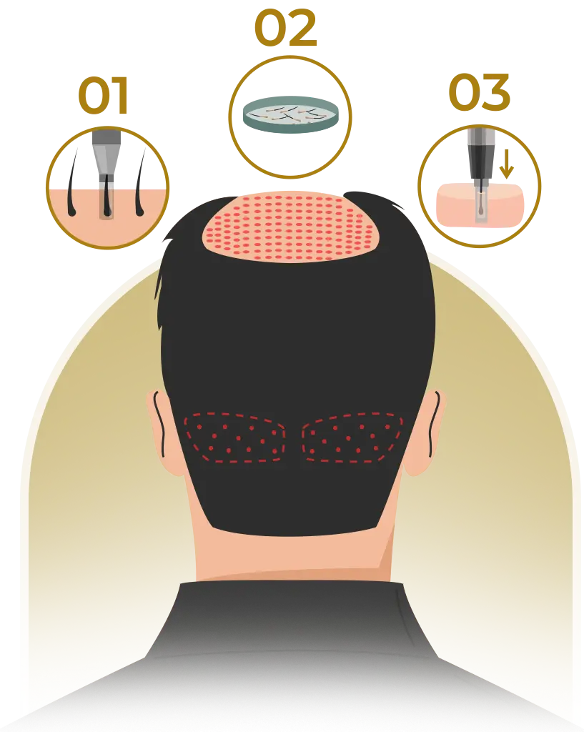 dhi hair transplant turkey