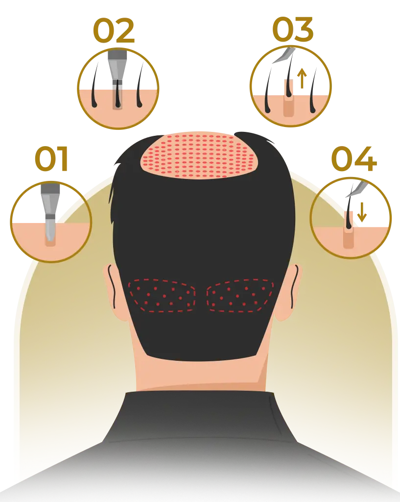 fue hair transplant turkey