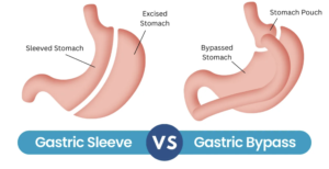 Gastric Bypass vs. Gastric Sleeve