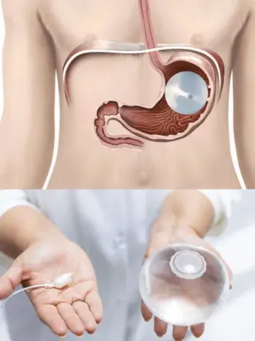 All-Inclusive-gastric-balloon-turkey-package-2025