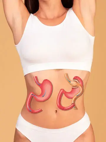 All-Inclusive-gastric-bypass-turkey-package-2025