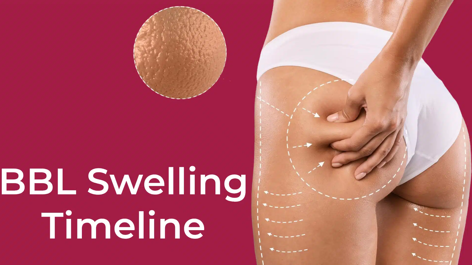 BBL Swelling Timeline