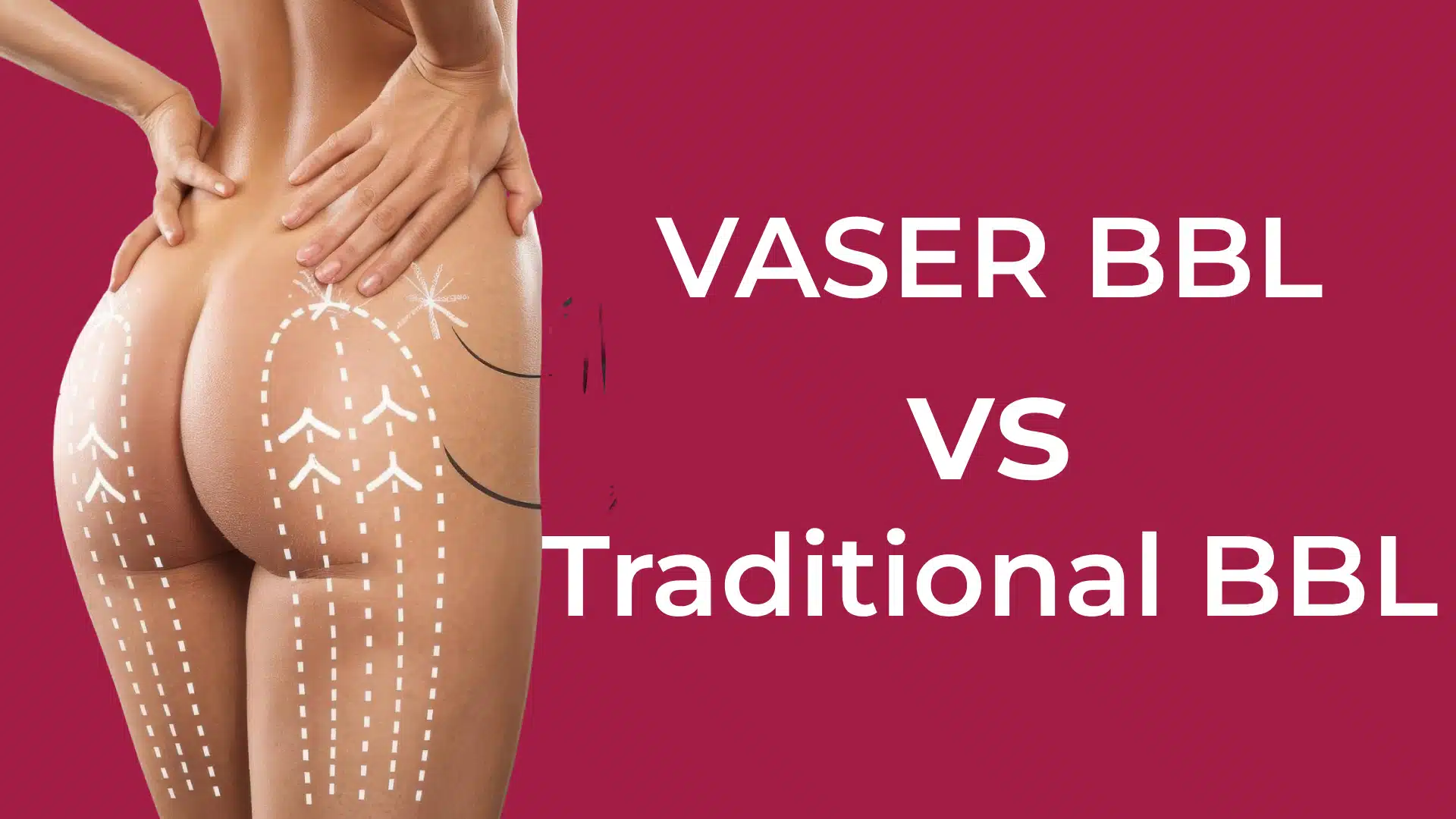 VASER BBL vs Traditional BBL