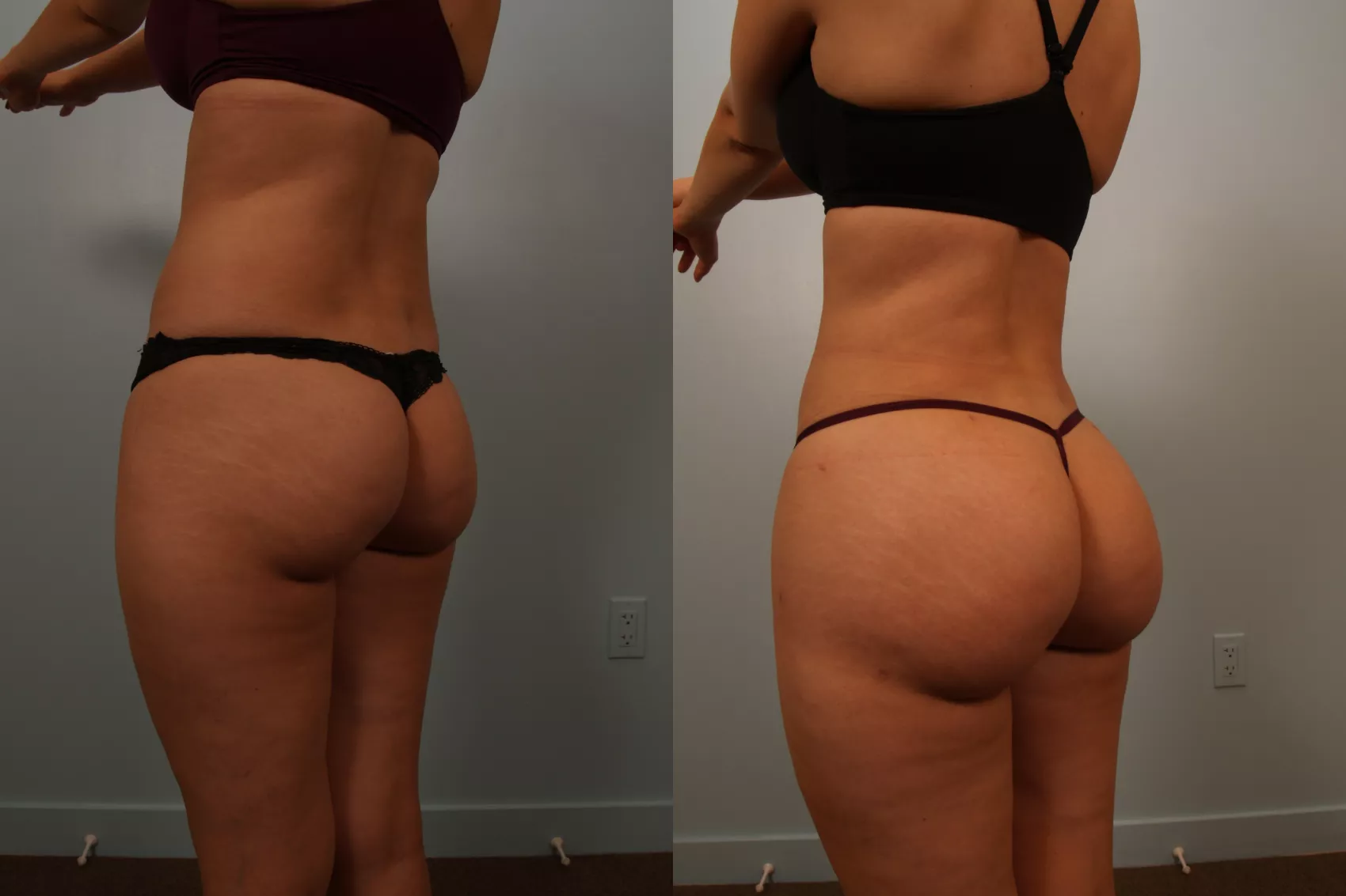BBL Turkey before and after - Brazilian Butt Lift results at Carely Clinic Istanbul