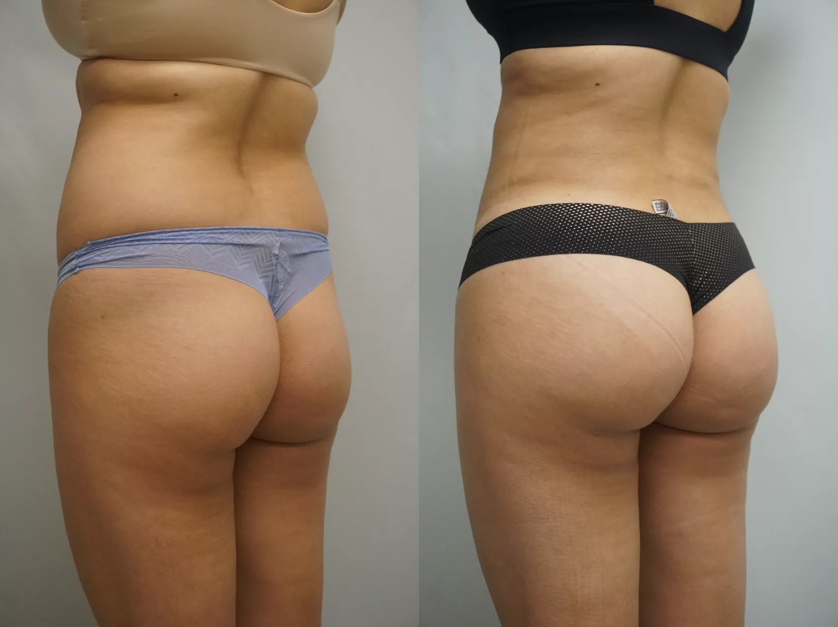 BBL Turkey results Case 10 - Buttocks augmentation before after