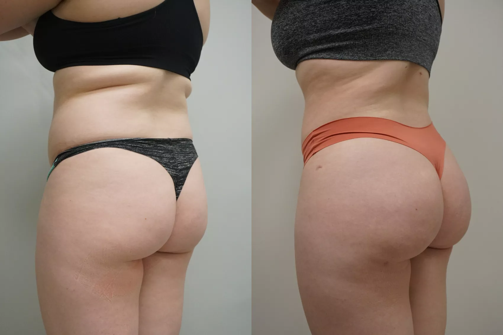 BBL before and after Turkey Case 11 - Brazilian Butt Lift patient results