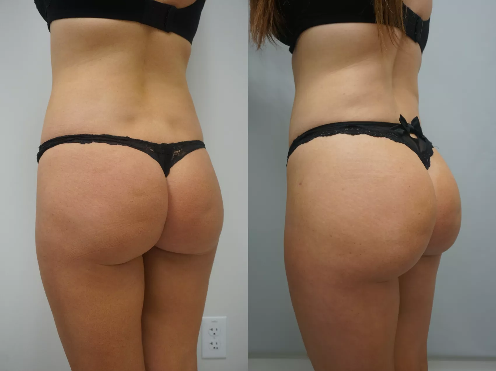 BBL Turkey Case 13 - Before and after buttocks enhancement