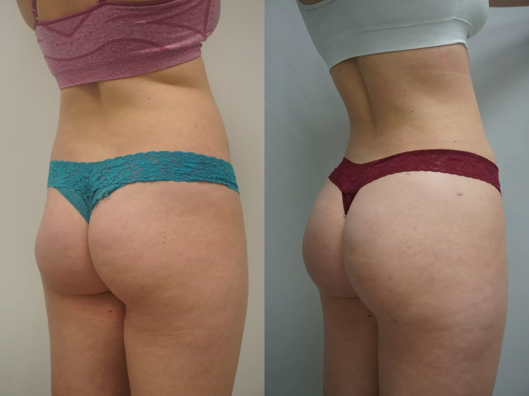 BBL Turkey results Case 4 - Before and after Brazilian Butt Lift surgery