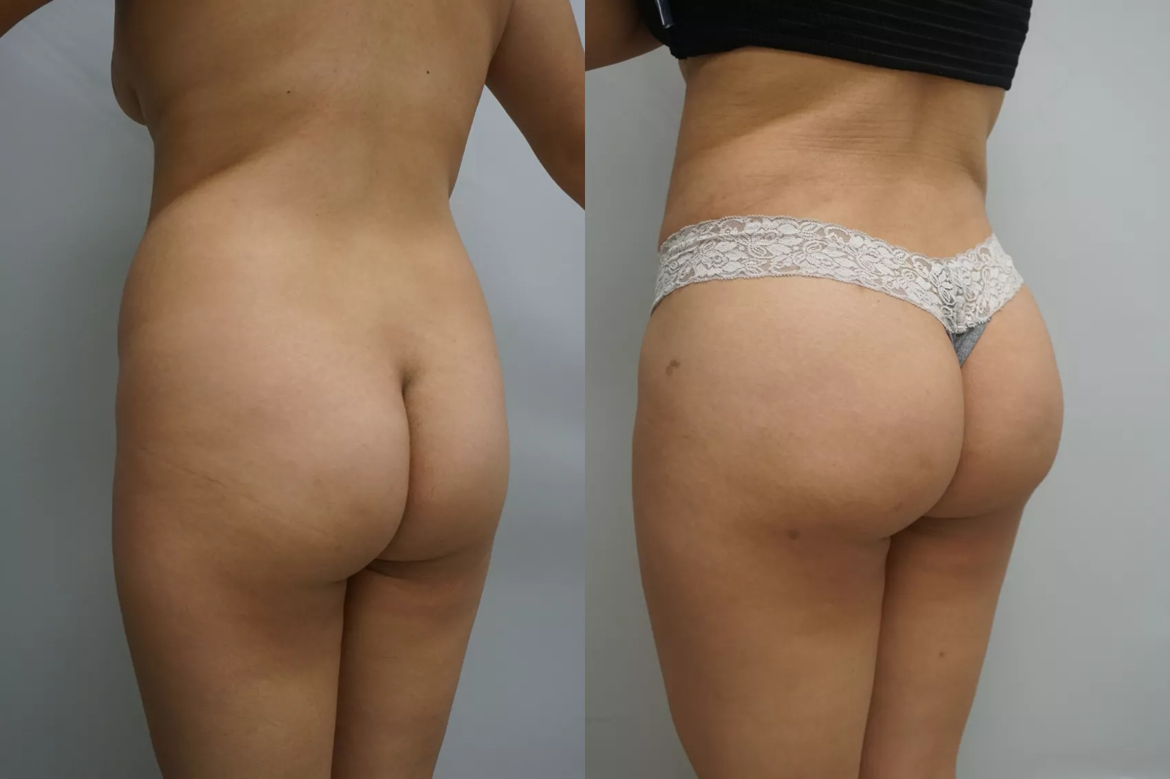 BBL before after Turkey Case 5 - Buttocks augmentation with fat transfer