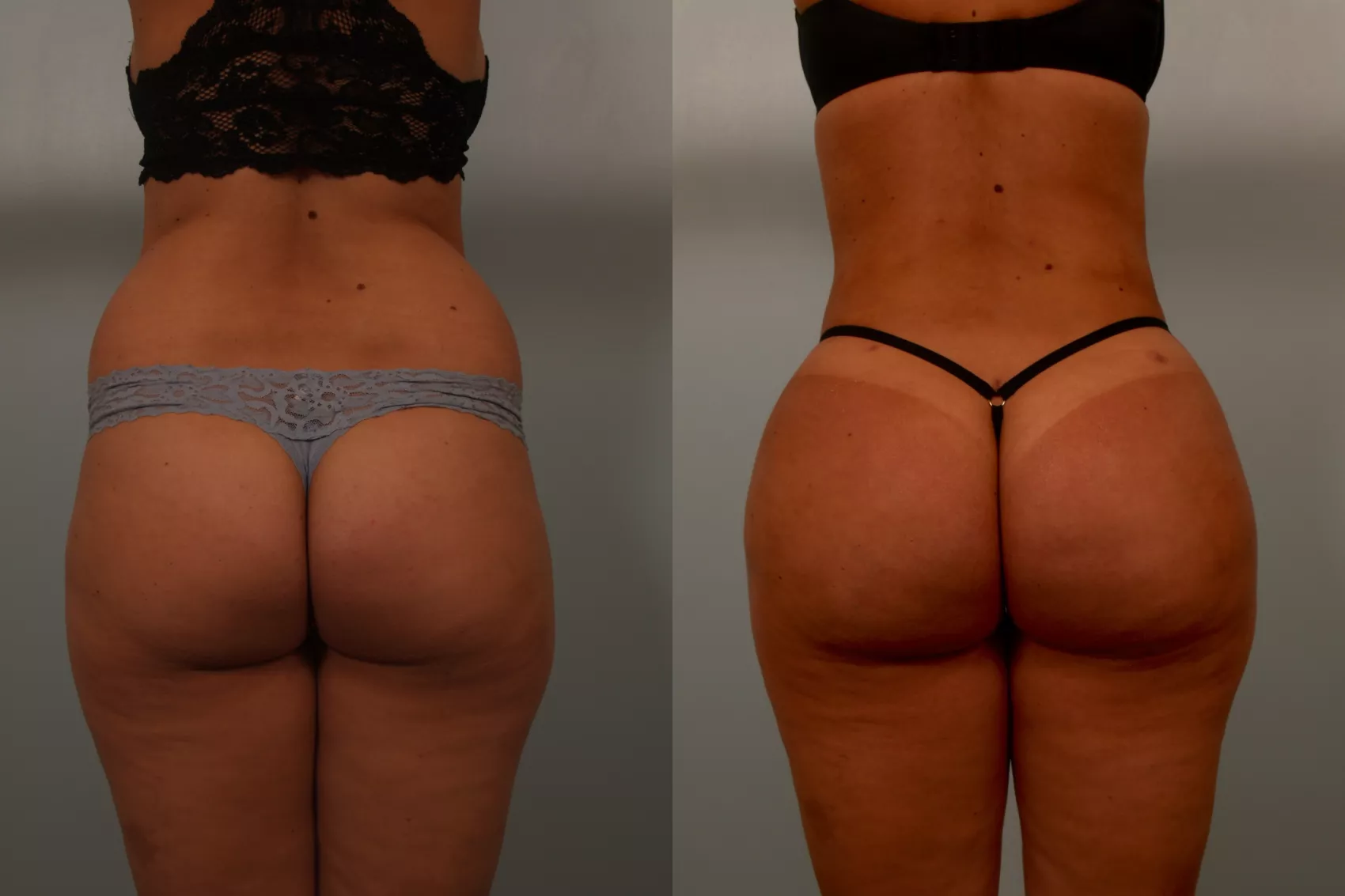 BBL Turkey before and after Case 7 - Brazilian Butt Lift transformation