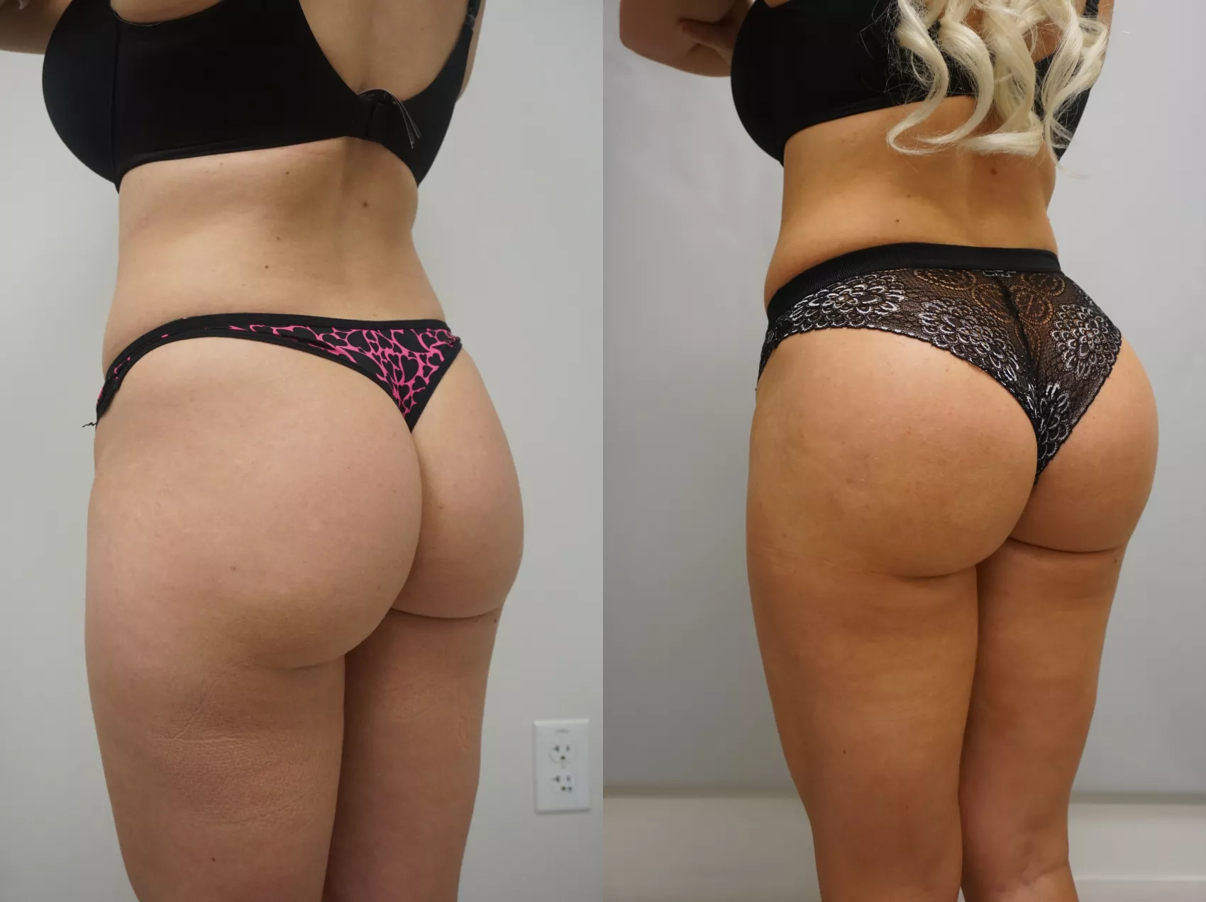 Brazilian Butt Lift Turkey Case 9 - Enhanced curves before and after
