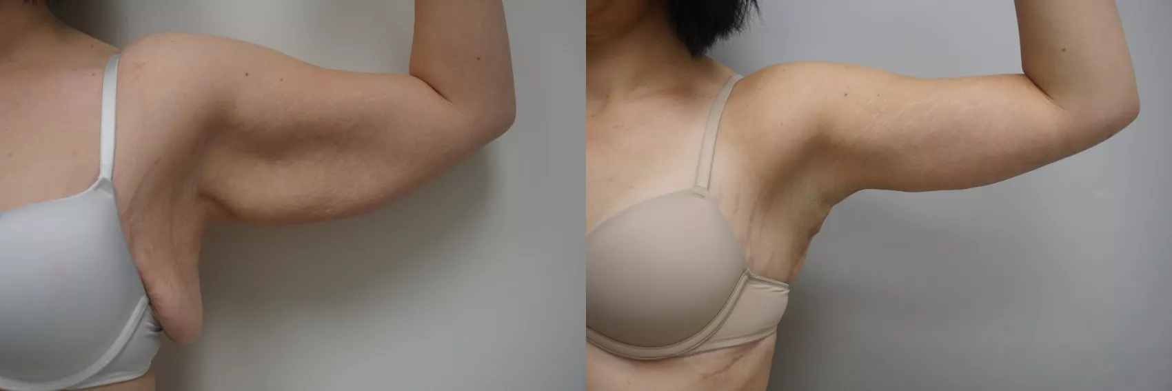 Arm lift Turkey before and after Case 1 - Bat wings removal at Carely Clinic Istanbul