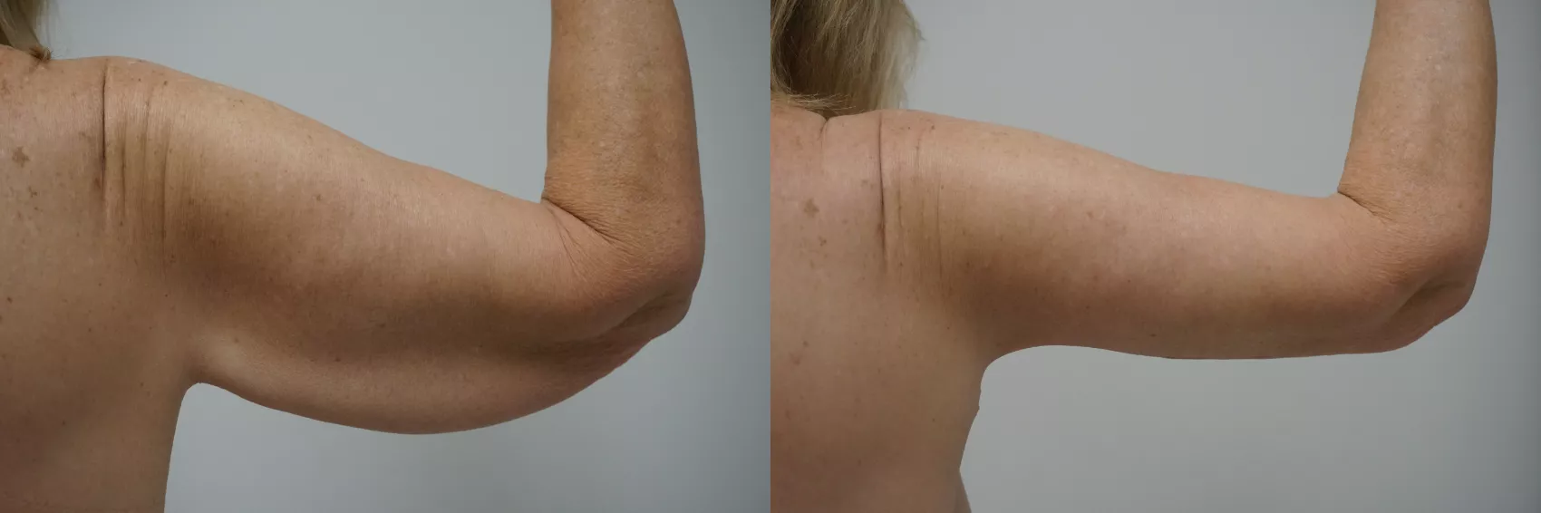 Arm lift Turkey Case 10