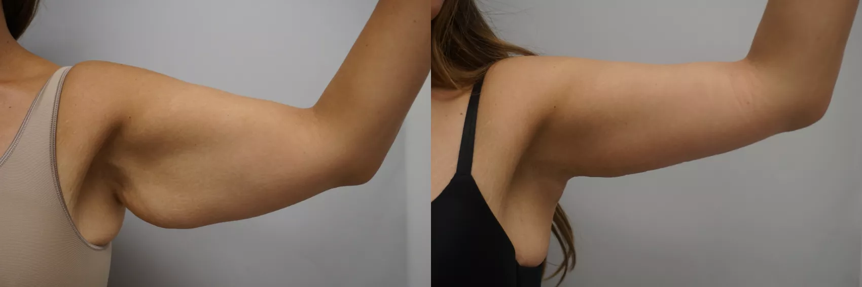 Arm lift Turkey Case 11