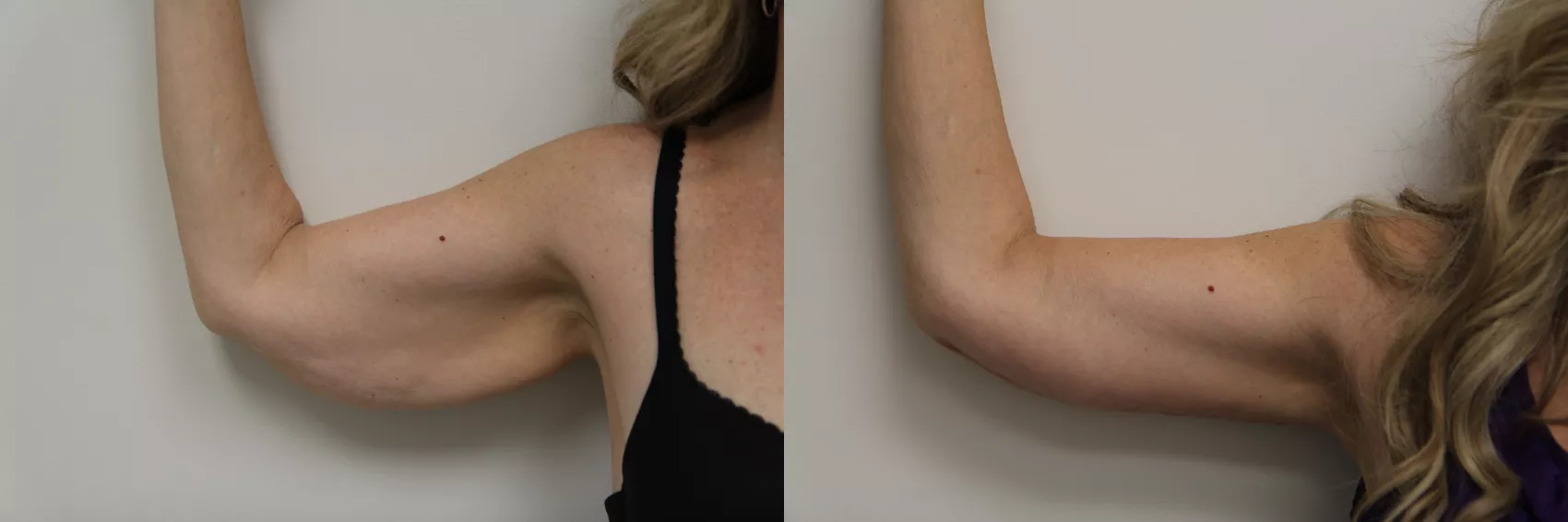 Arm lift Turkey Case 12