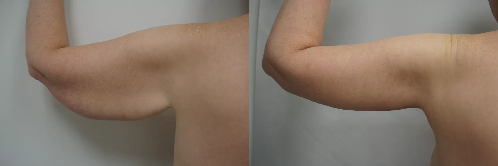 Arm lift Turkey after weight loss