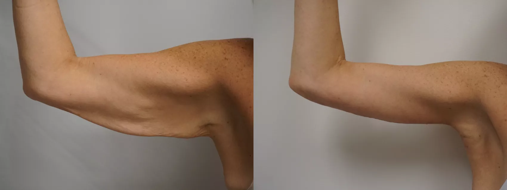 Arm lift Turkey before and after Case 2 - Brachioplasty results
