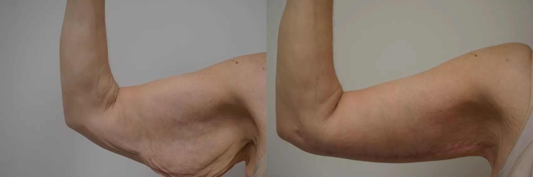 Arm lift Turkey Case 3 - Upper arm contouring