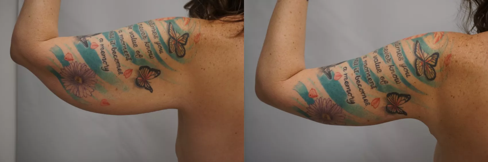 Arm lift Turkey Case 4 - Bingo wings removal