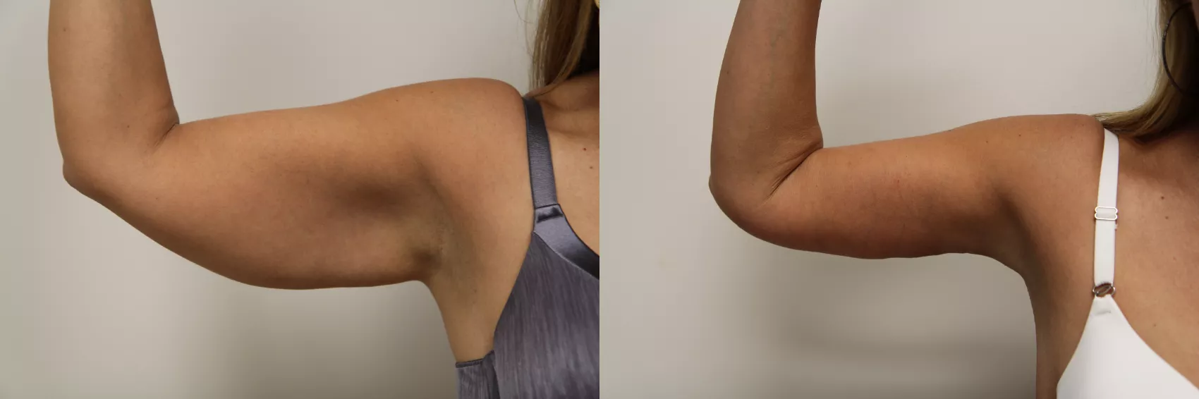 Arm lift Turkey Case 5 - Post weight loss arm surgery