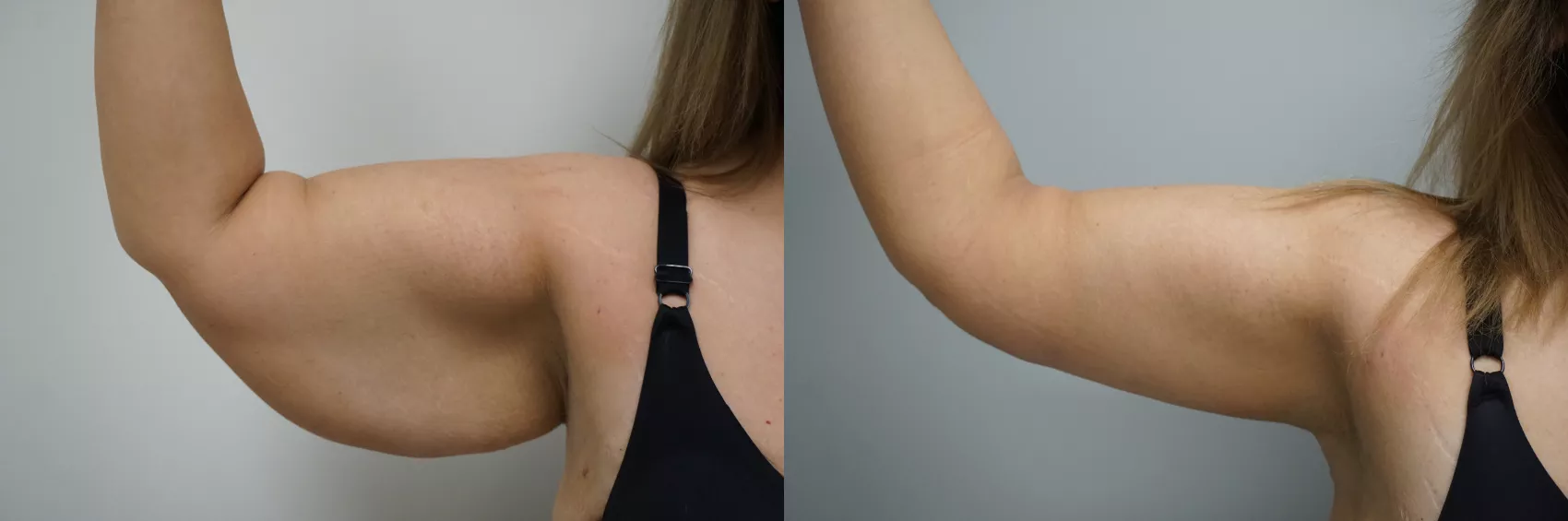 Arm lift Turkey Case 6 - Excess skin removal