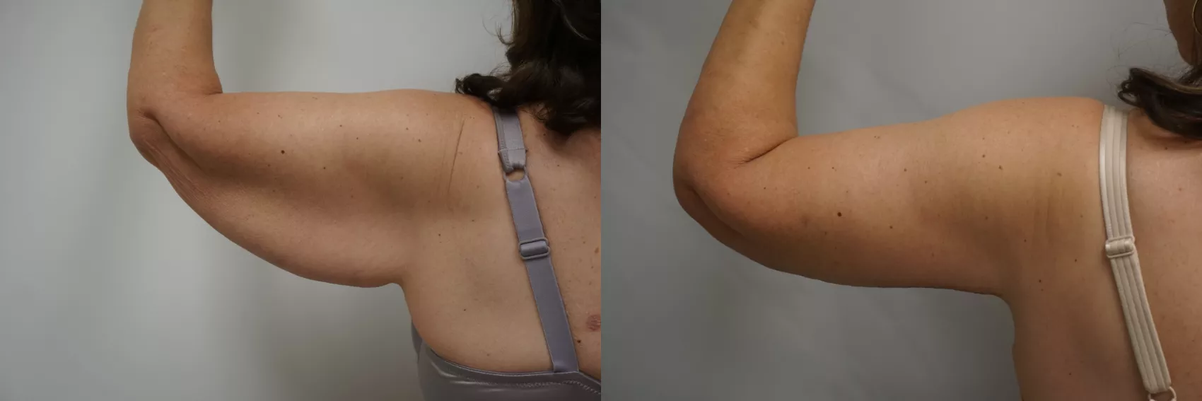 Arm lift Turkey Case 7 - Toned arms transformation