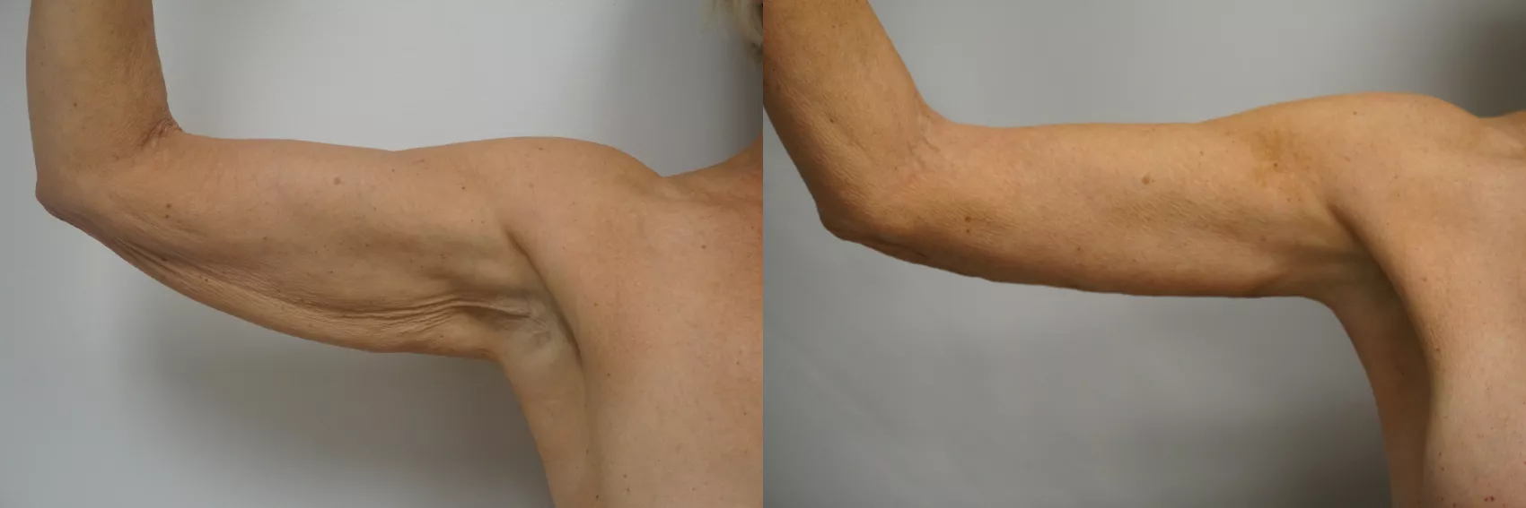 Arm lift Turkey Case 8 - Brachioplasty transformation