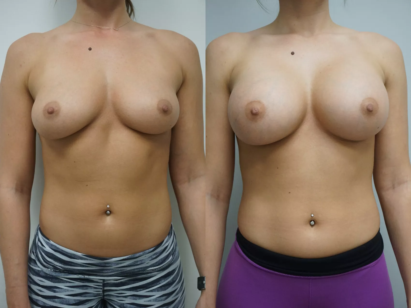 Breast augmentation Turkey Case 7 - Dual plane placement results