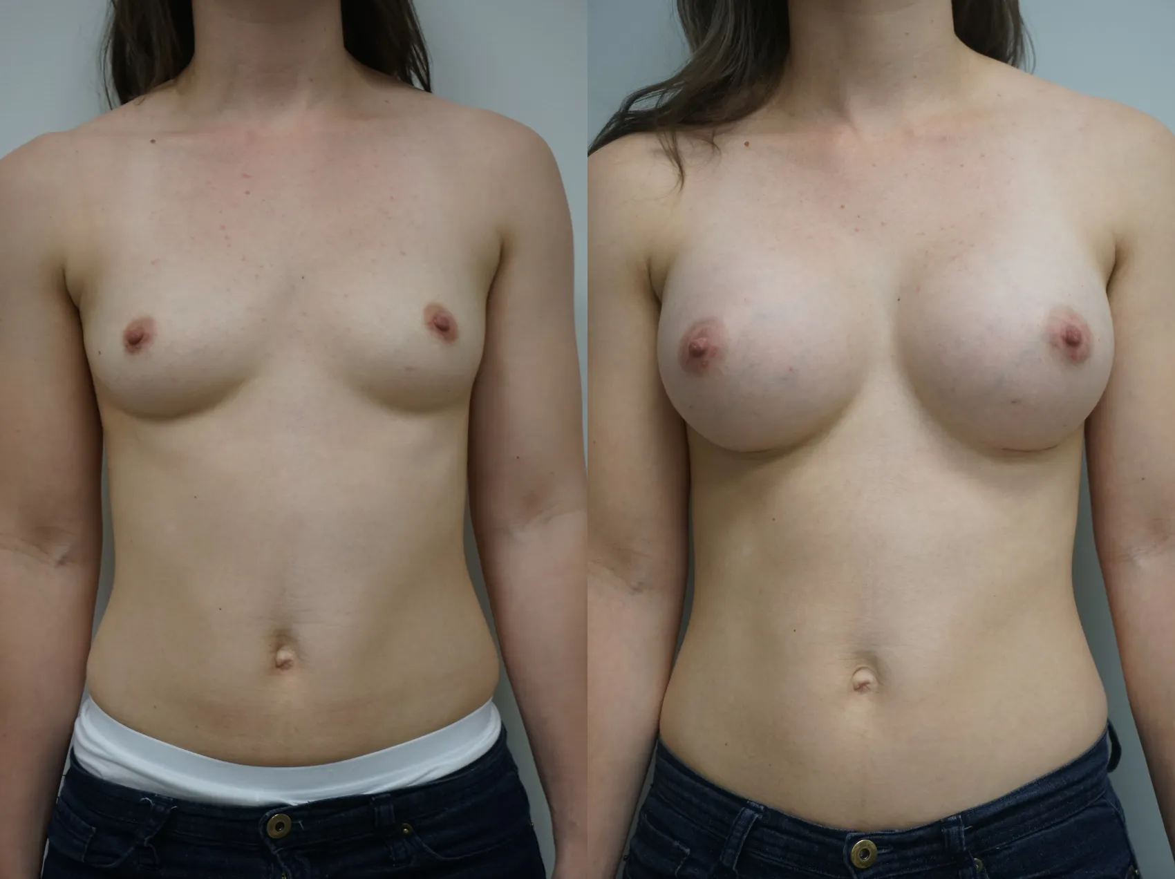 Breast implants Turkey Case 9 - Mentor implants results
