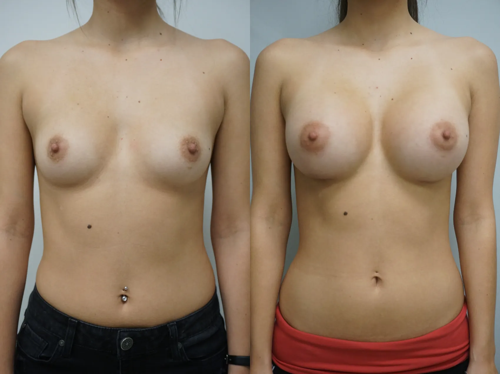 Breast augmentation Turkey Case 10 - Round implants transformation