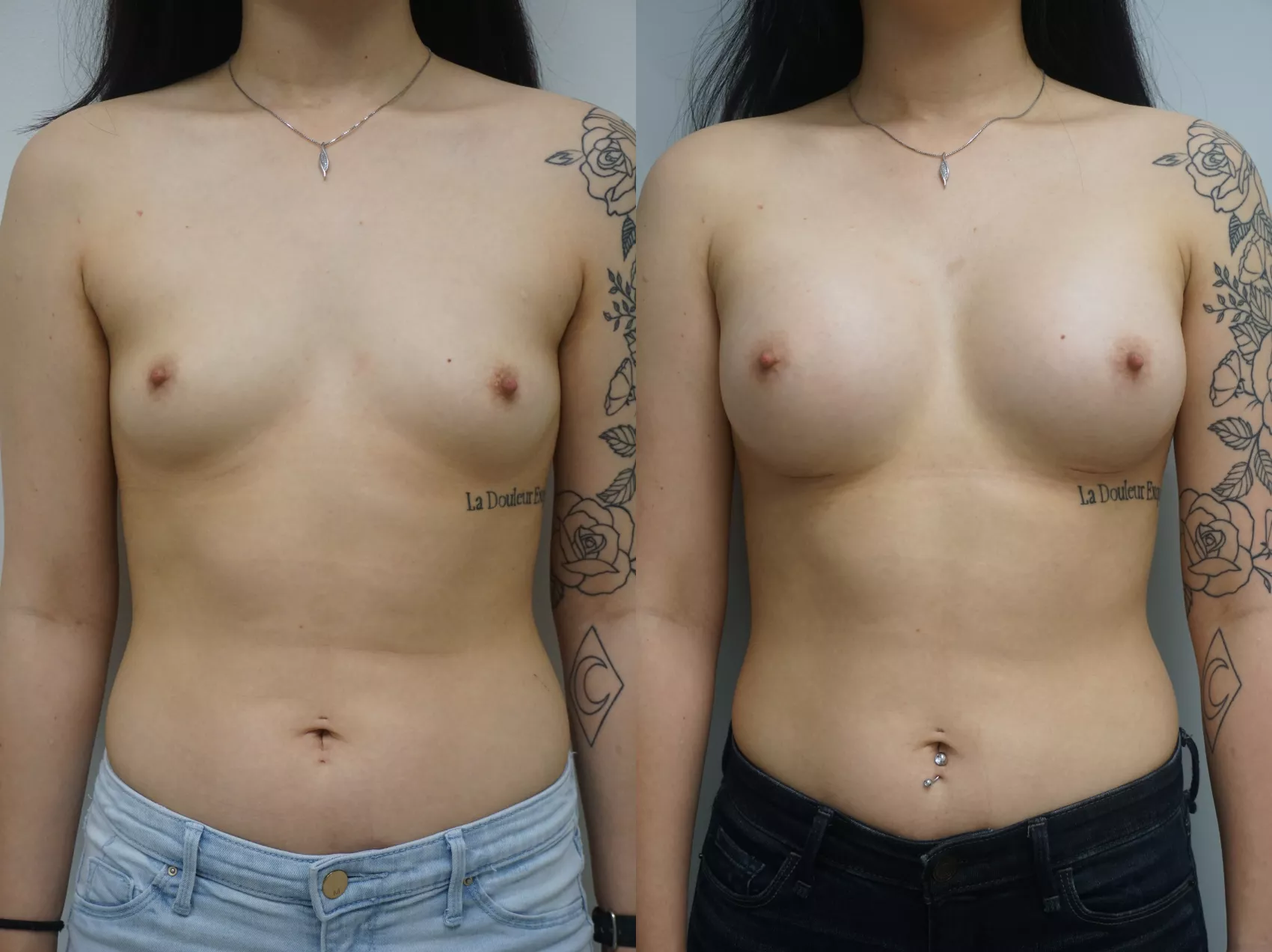 Breast augmentation results Turkey Case 11 - Proportionate enhancement