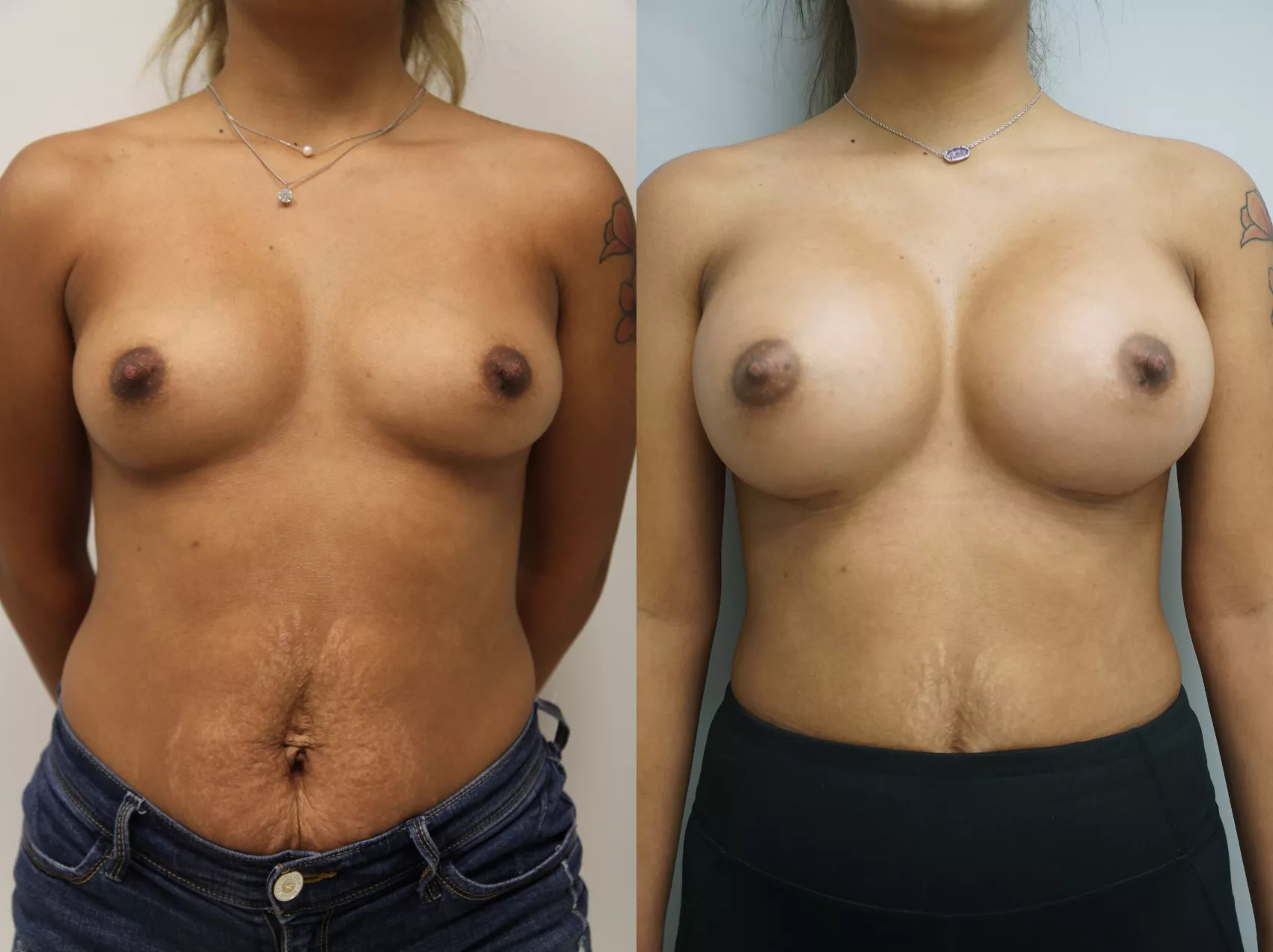 Breast implants before after Turkey Case 12 - Submuscular placement