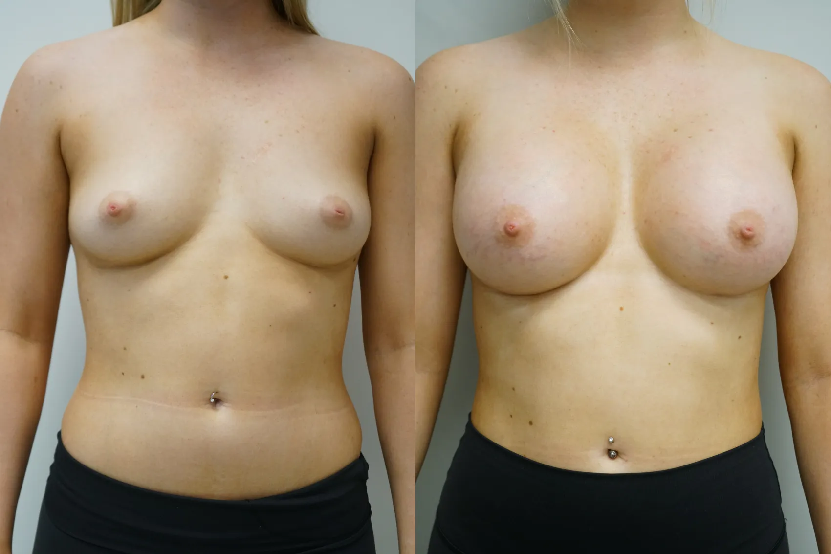 Breast augmentation Turkey Case 13 - High profile implants