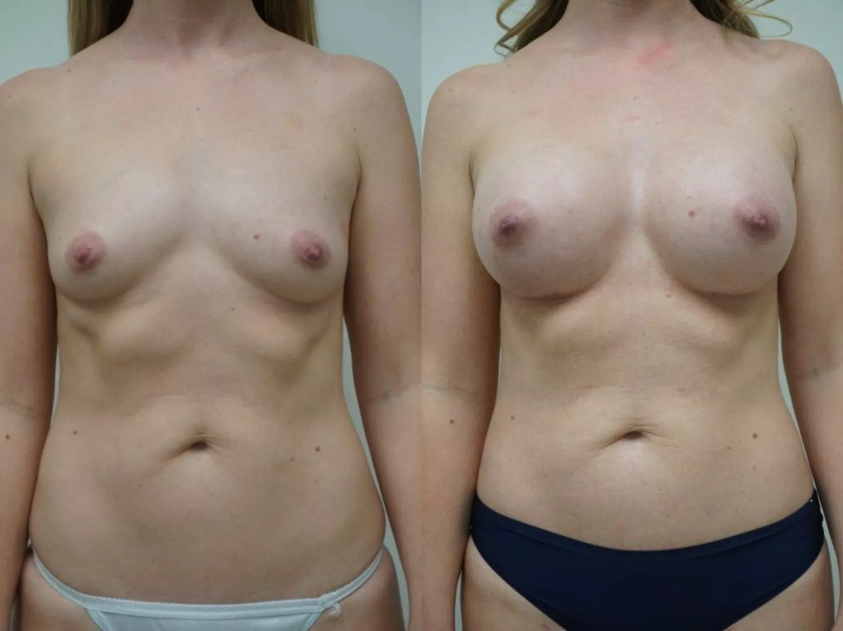 Breast implants Turkey Case 6 - Silicone implants transformation