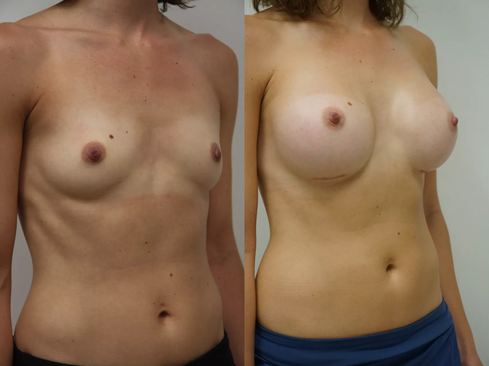 Breast augmentation before after Turkey Case 5 - Natural enhancement