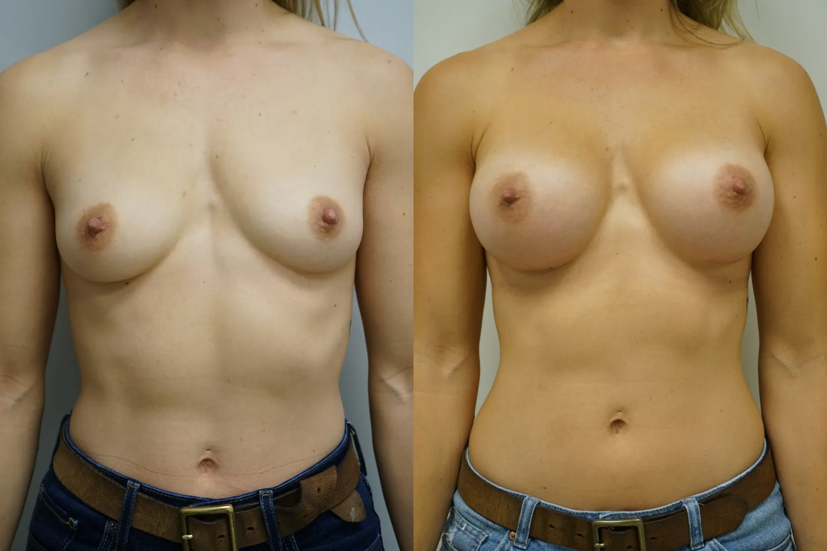 Breast augmentation Turkey results Case 4 - Premium Motiva implants
