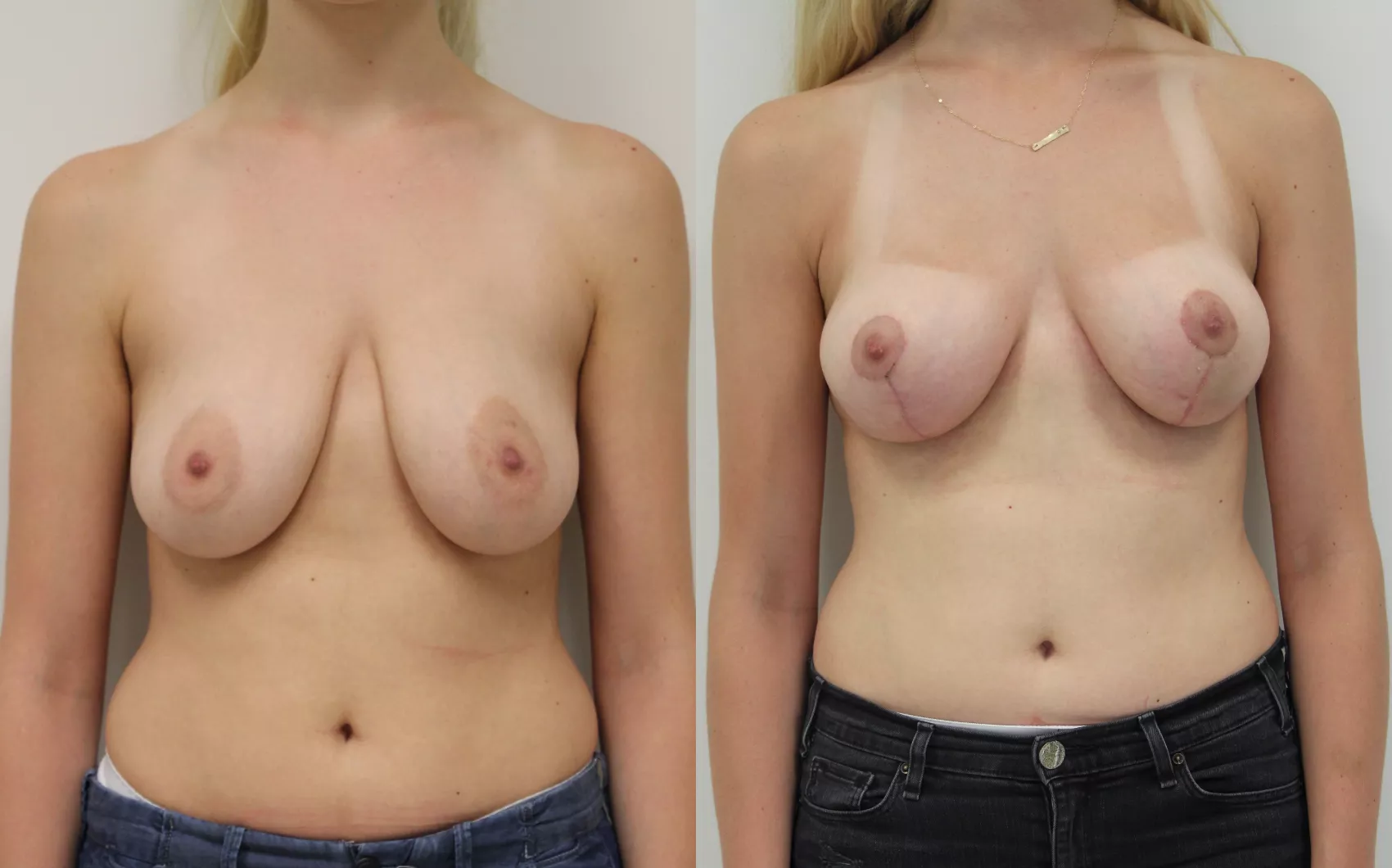 Breast lift Turkey before and after Case 1 - Mastopexy results at Carely Clinic Istanbul