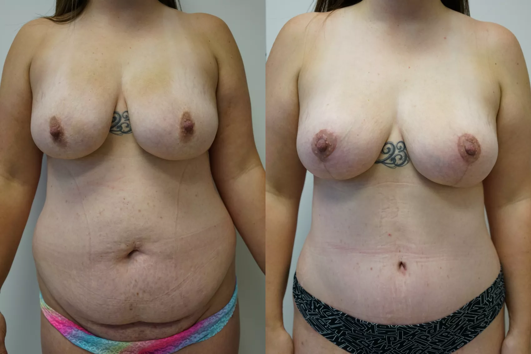Breast lift Turkey results Case 10 - Firmer breast contour achieved